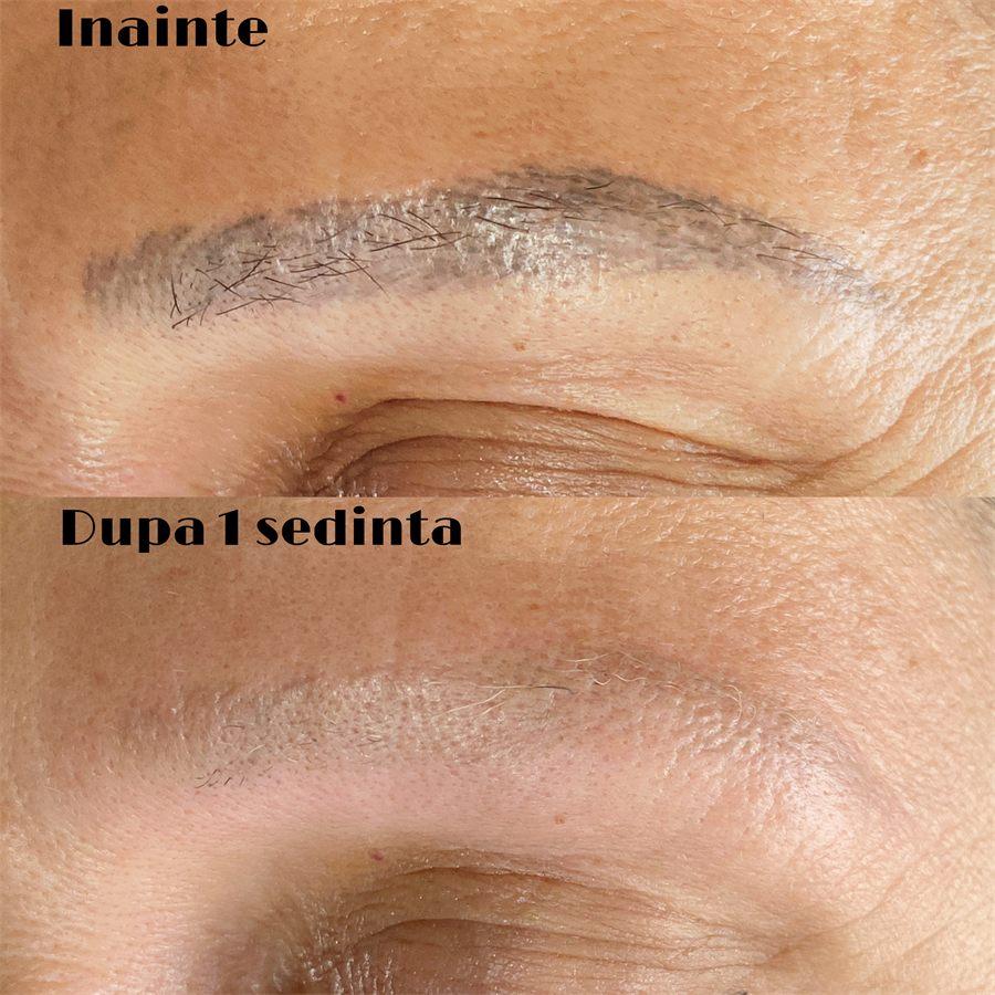 Îndepărtare tatuaj – înainte și după o ședință