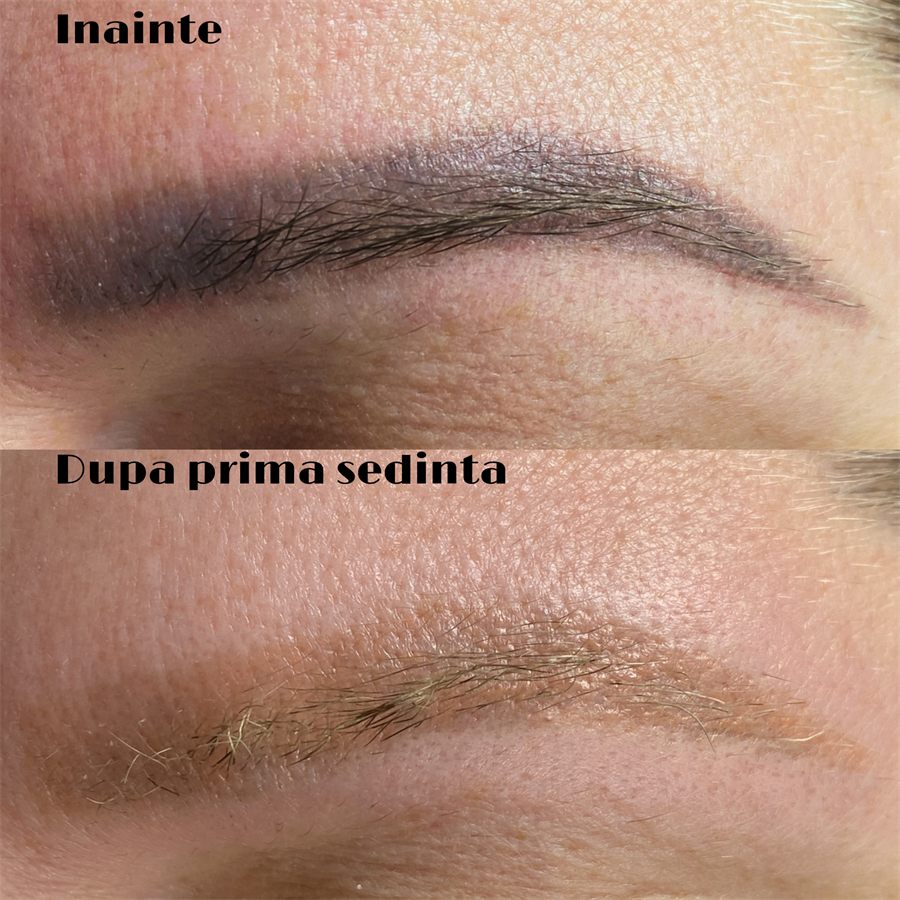 Îndepărtare micropigmentare sprâncene – înainte și după prima ședință, Cartierul Arhitecților