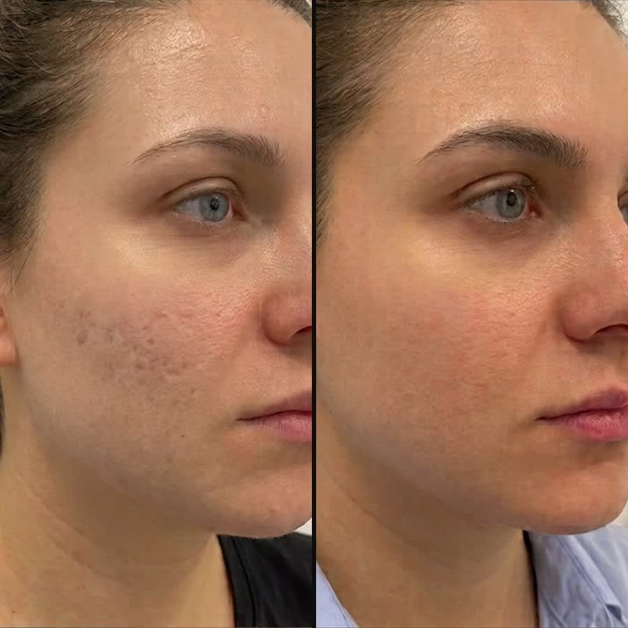 Tratament facial pentru textura pielii – înainte și după, Salon Venus Sibiu